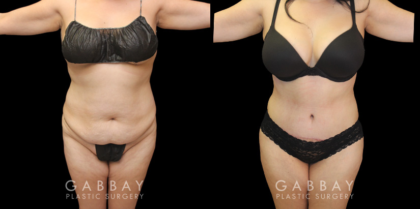 Patient results following her tummy tuck procedure with Dr. Gabby in Beverly Hills. Loose skin and pockets of fat were removed to create a natural-looking slimmer figure.