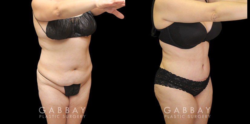 Patient results following her tummy tuck procedure with Dr. Gabby in Beverly Hills. Loose skin and pockets of fat were removed to create a natural-looking slimmer figure.