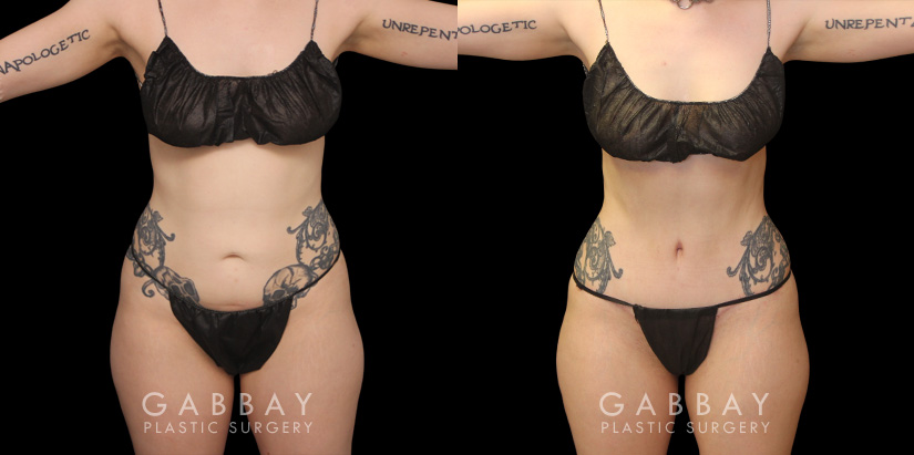 Younger female tummy tuck patient before and after her procedure. Abdominal tightening resulted in a flatter stomach while also eliminating the rolling effect of the skin while seated. Note the patient was able to maintain her natural curvy figure.