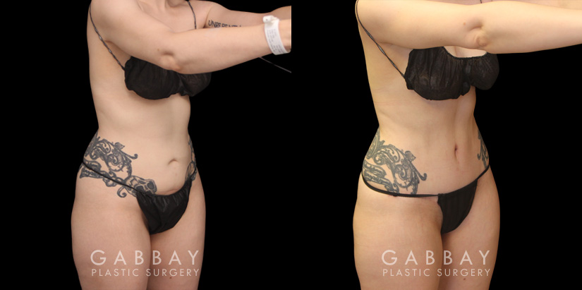 Younger female tummy tuck patient before and after her procedure. Abdominal tightening resulted in a flatter stomach while also eliminating the rolling effect of the skin while seated. Note the patient was able to maintain her natural curvy figure.