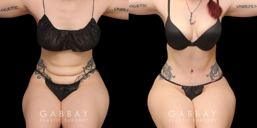 Younger female tummy tuck patient before and after her procedure. Abdominal tightening resulted in a flatter stomach while also eliminating the rolling effect of the skin while seated. Note the patient was able to maintain her natural curvy figure.