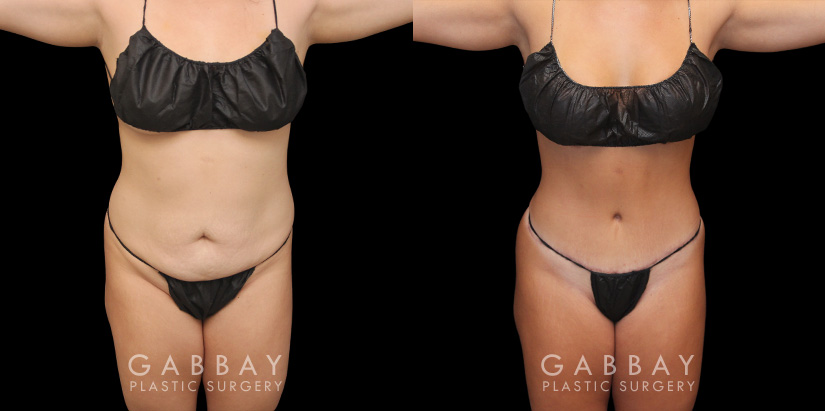 Patient before and after abdominoplasty from multiple angles. Not the improvements while standing and seated, removing the effect of bunching skin and stomach fat, and restoring a flat tightness to the area.