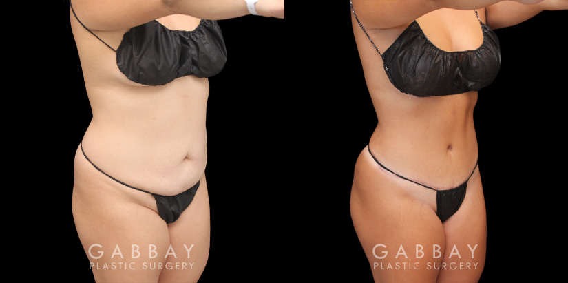 Patient before and after abdominoplasty from multiple angles. Not the improvements while standing and seated, removing the effect of bunching skin and stomach fat, and restoring a flat tightness to the area.