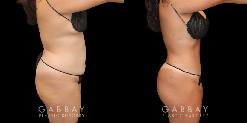 Patient before and after abdominoplasty from multiple angles. Not the improvements while standing and seated, removing the effect of bunching skin and stomach fat, and restoring a flat tightness to the area.