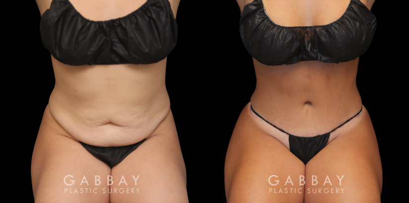 Patient before and after abdominoplasty from multiple angles. Not the improvements while standing and seated, removing the effect of bunching skin and stomach fat, and restoring a flat tightness to the area.