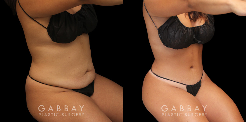Patient before and after abdominoplasty from multiple angles. Not the improvements while standing and seated, removing the effect of bunching skin and stomach fat, and restoring a flat tightness to the area.