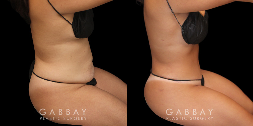 Patient before and after abdominoplasty from multiple angles. Not the improvements while standing and seated, removing the effect of bunching skin and stomach fat, and restoring a flat tightness to the area.